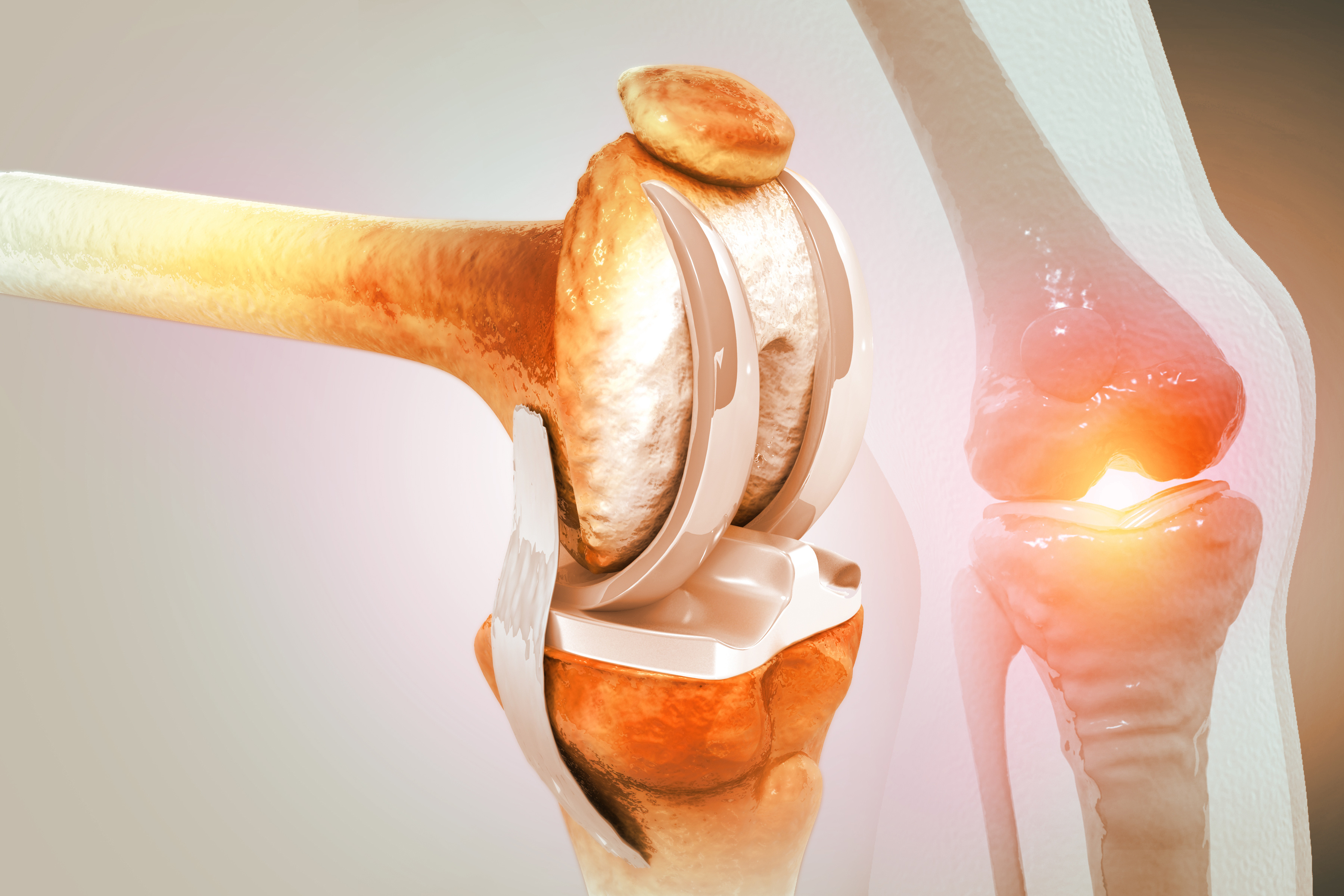 Halbschlitten versus Totalendoprothese